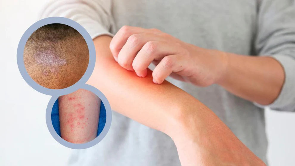 CICLOPIROX FORTE 8%- ELIMINA LA TIÑA INGUINAL